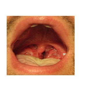 Adult in strep throat